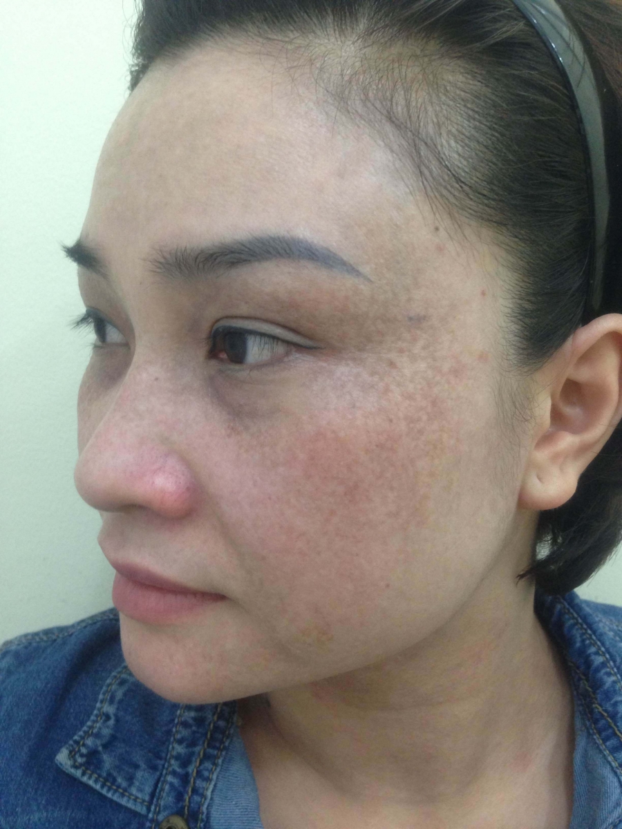 khuôn mặt bị tàn nhang